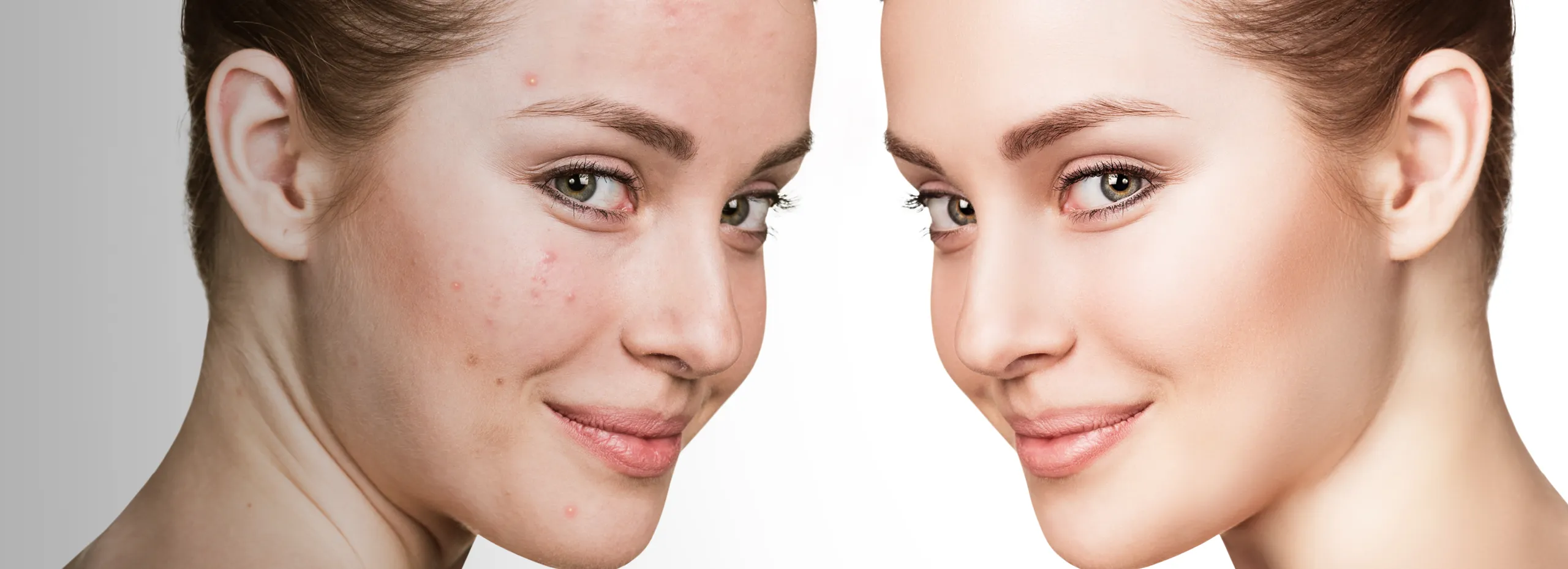 Eine Person mit halbem Gesicht im Profil. Links sichtbare Hautunreinheiten, rechts glatte Haut. Beide Gesichtshälften haben einen ähnlichen Ausdruck mit einem leichten Lächeln und zurückgebundenem Haar. Hintergrund von grau nach weiß verlaufend.